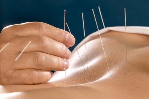 acupuncture york